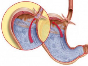 Гастроезофагеальна рефлюксна хвороба